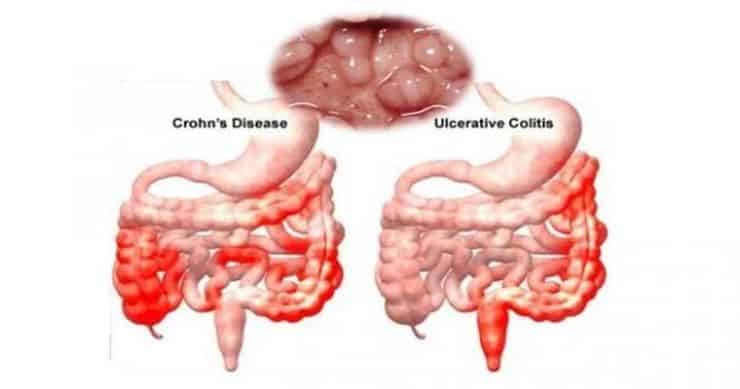 alimentación en colitis ulcerosa nutricionista
