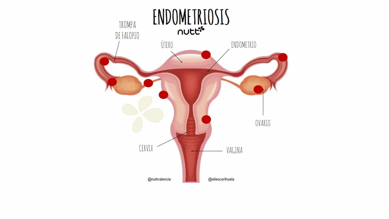 endometriosis nutricionista Valencia