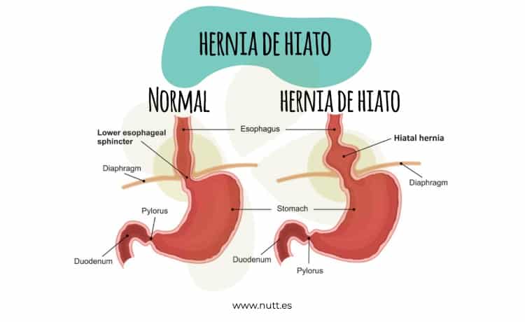 dieta para la hernia de hiato nutricionista valencia nutt