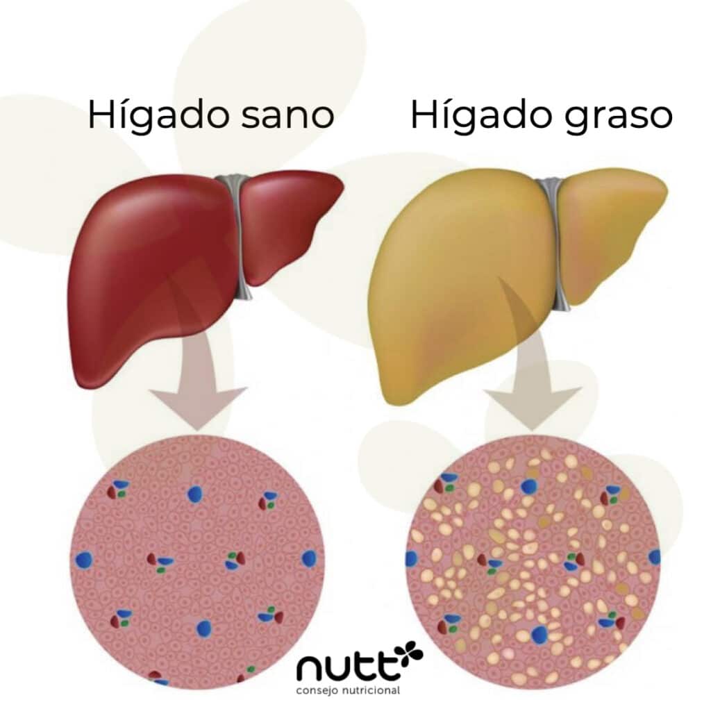 hígado graso no alcoholico dieta nutricionista